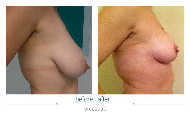 Breast Reduction Before and After