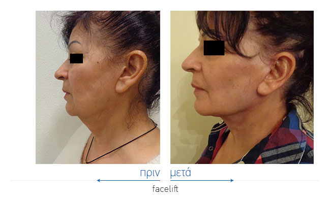 Facelift Before and After