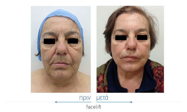 Facelift Before and After