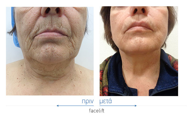 Facelift Before and After