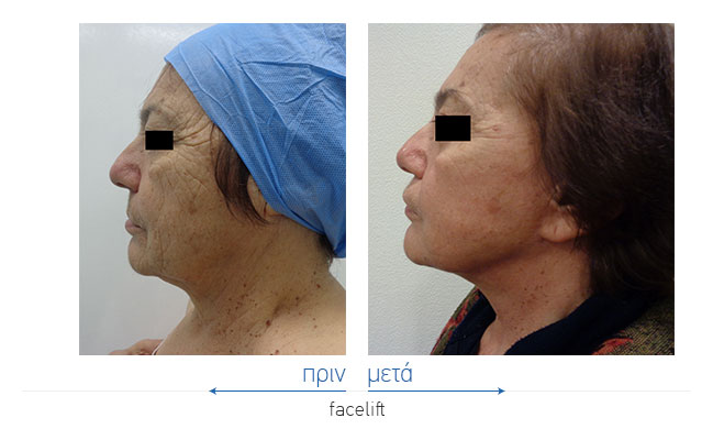 Facelift Before and After