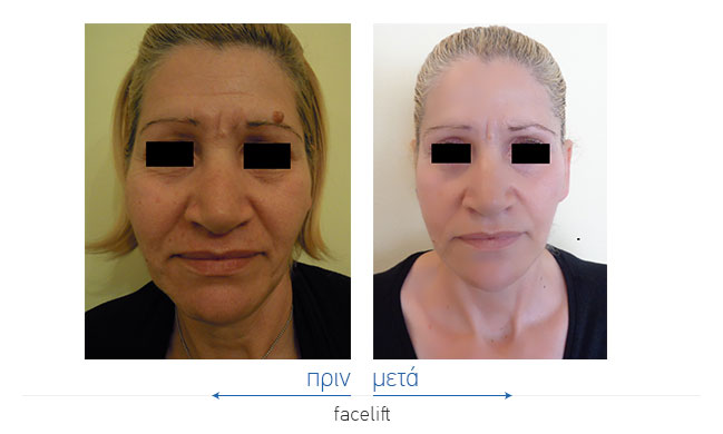 Facelift Before and After