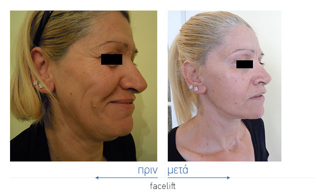 Facelift Before and After