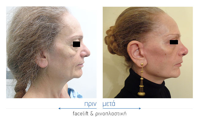 Facelift Before and After