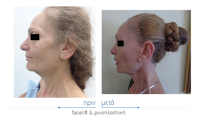 Facelift Before and After