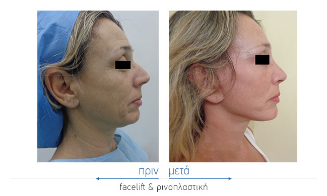 Facelift Before and After
