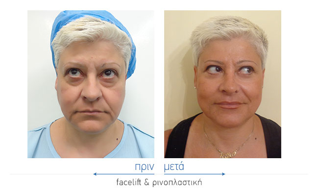 Facelift Before and After