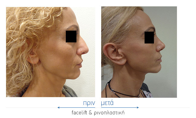 Facelift Before and After