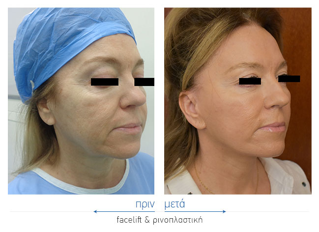 Facelift Before and After