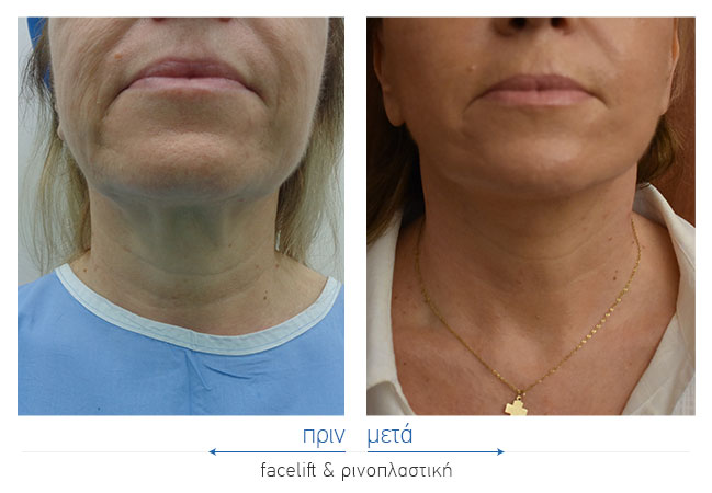 Facelift Before and After