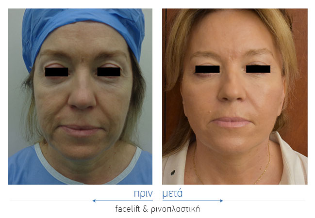 Facelift Before and After