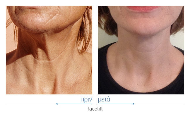 Facelift Before and After