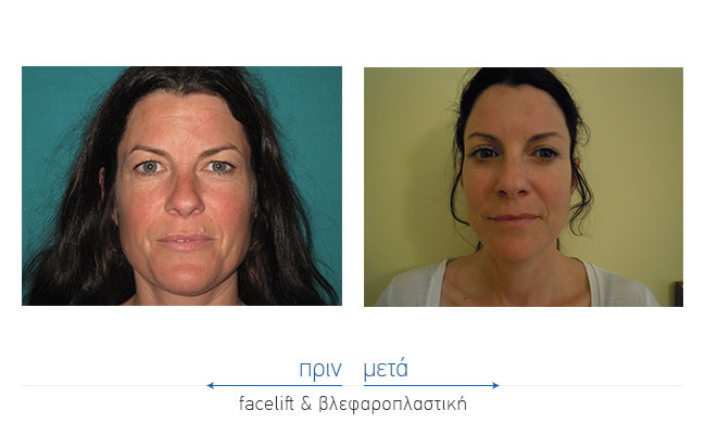 Facelift Before and After