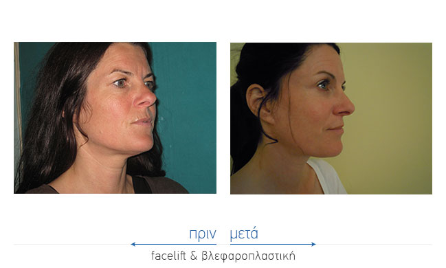 Facelift Before and After