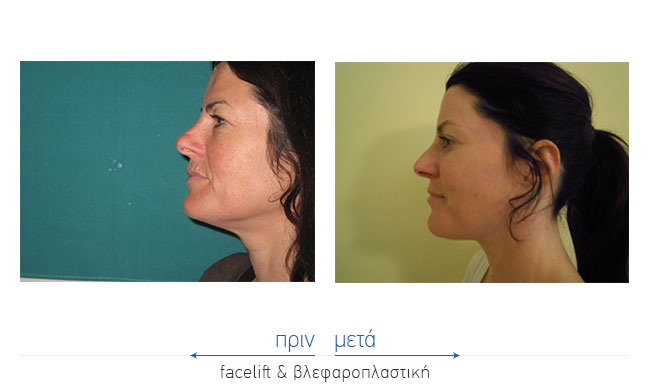 Facelift Before and After