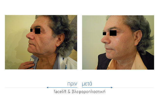 Facelift Before and After