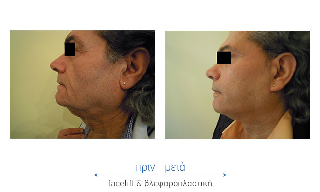 Facelift Before and After