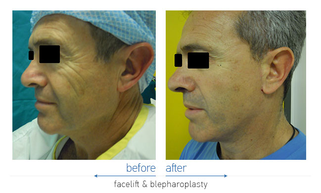 Facelift Before and After