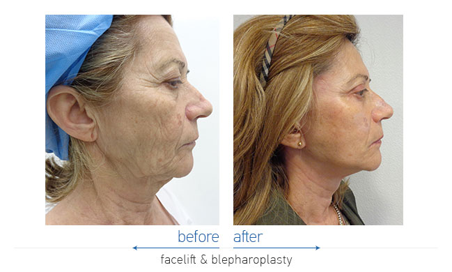 Facelift Before and After