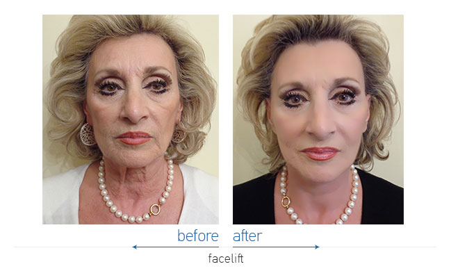 Facelift Before and After