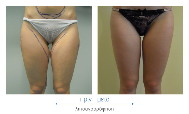 Liposuction Before and After