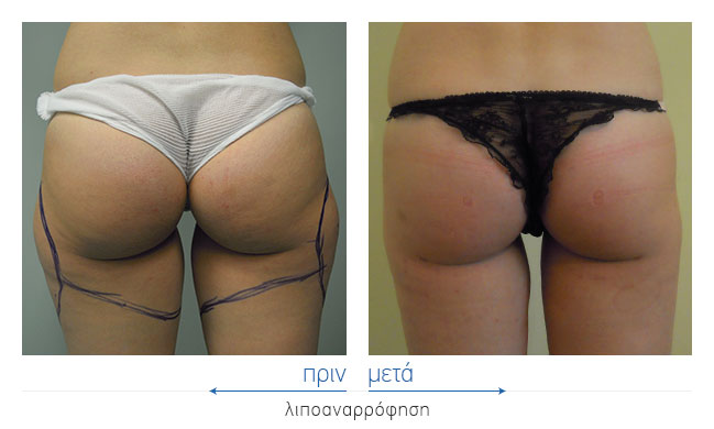 Liposuction Before and After