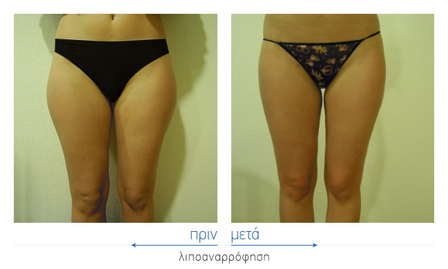 Liposuction Before and After