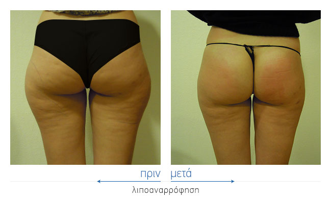 Liposuction Before and After