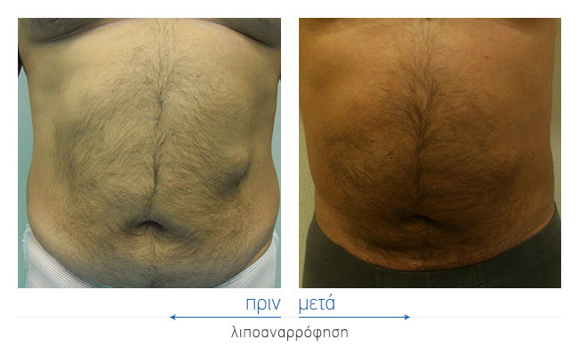 Liposuction Before and After