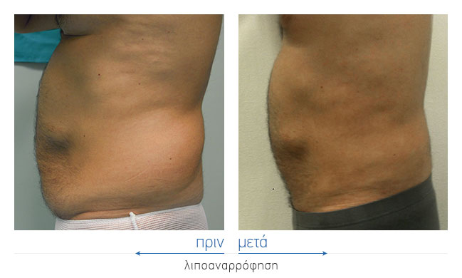 Liposuction Before and After