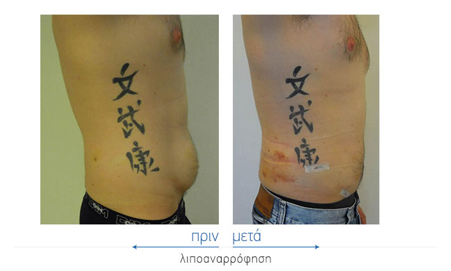 Liposuction Before and After