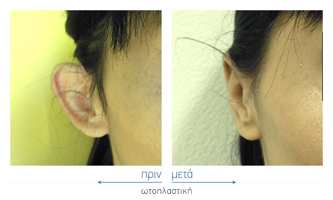 Otoplasty Before and After