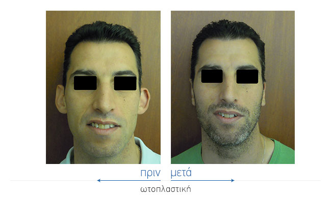 Otoplasty Before and After