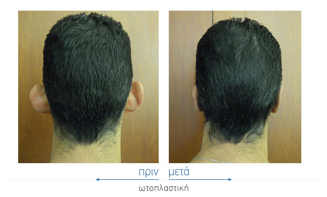 Otoplasty Before and After
