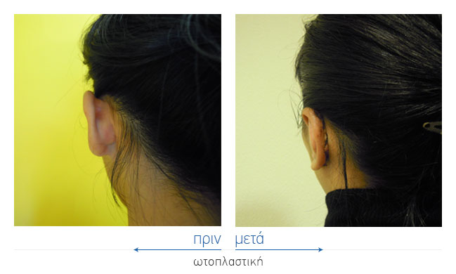 Otoplasty Before and After