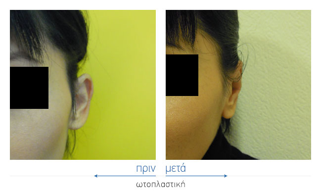 Otoplasty Before and After