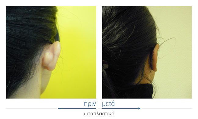 Otoplasty Before and After