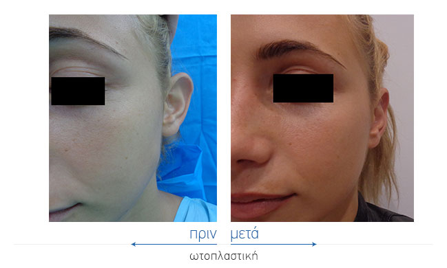 Otoplasty Before and After