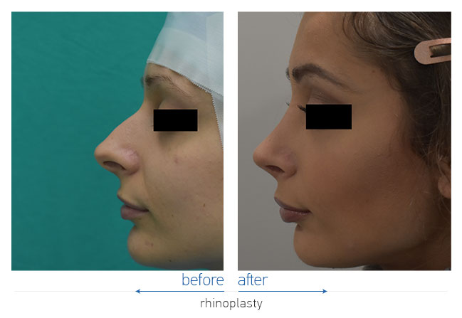 Rhinoplasty Before and After