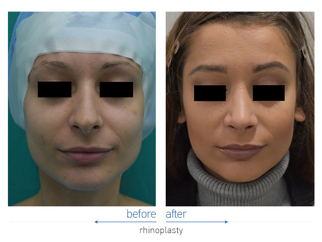 Rhinoplasty Before and After