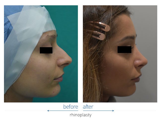 Rhinoplasty Before and After