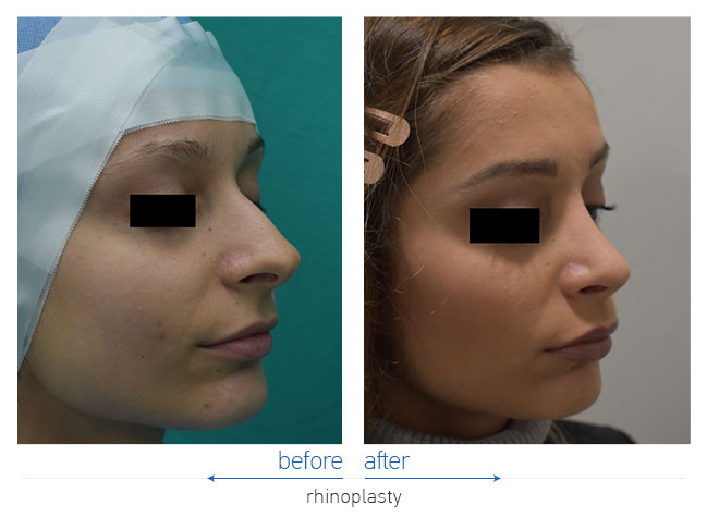 Rhinoplasty Before and After