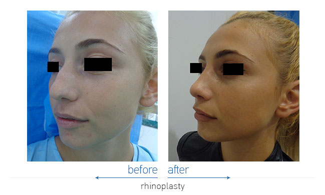 Rhinoplasty Before and After