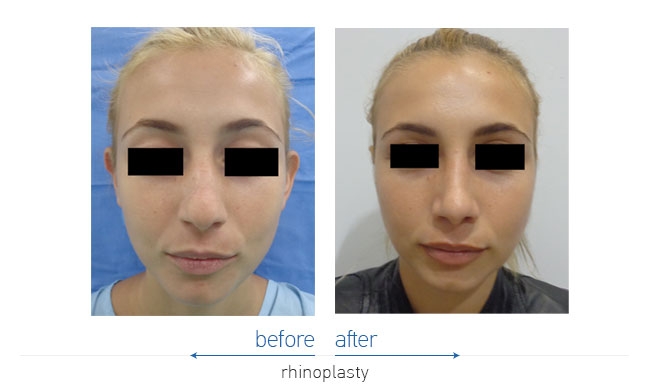 Rhinoplasty Before and After