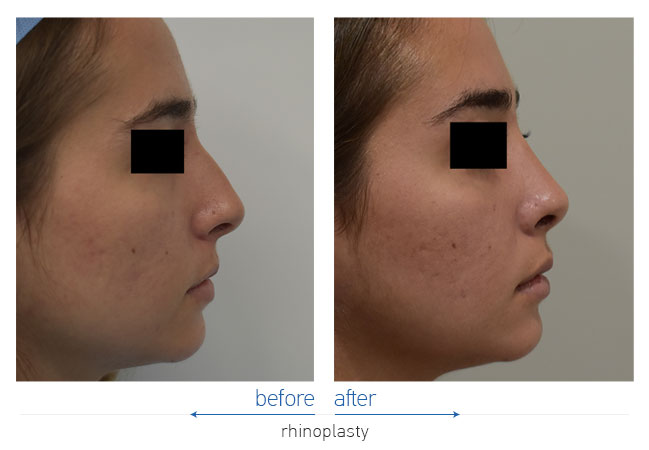 Rhinoplasty Before and After