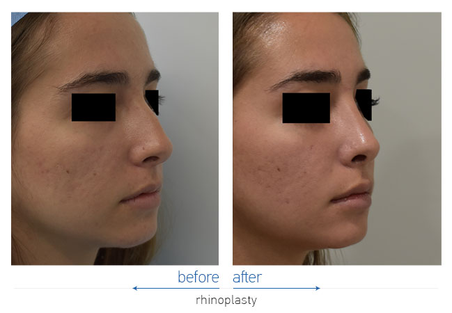 Rhinoplasty Before and After