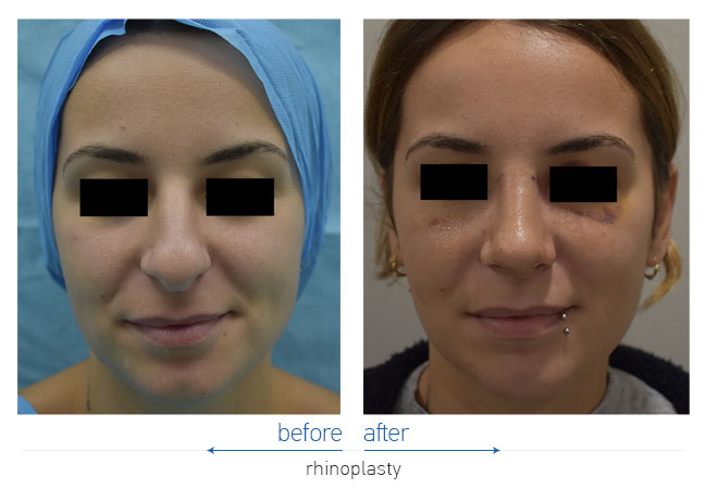 Rhinoplasty Before and After