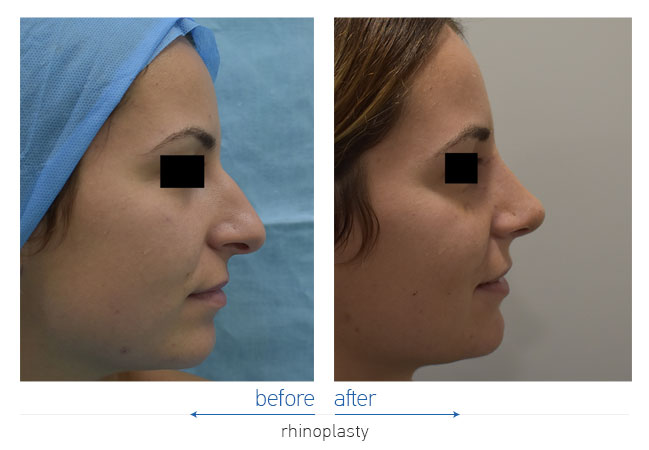 Rhinoplasty Before and After