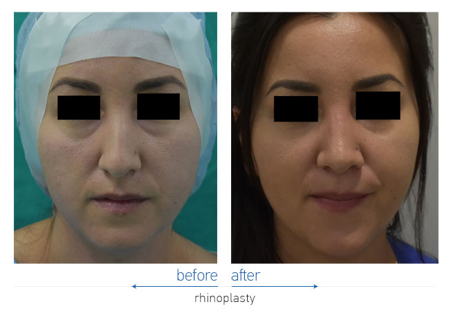 Rhinoplasty Before and After