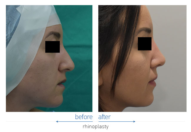 Rhinoplasty Before and After